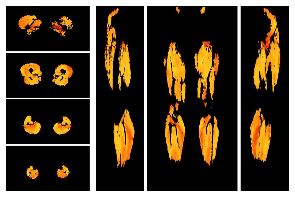 Muscle fiber tract angle map based on whole leg DTI based fiber tractography.