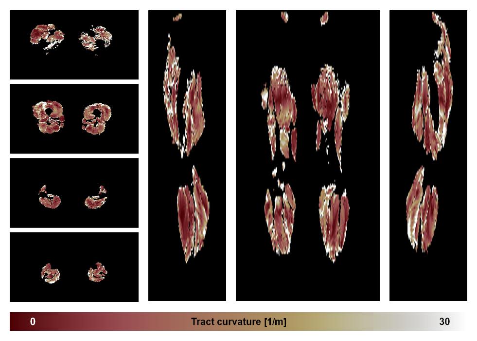 Muscle fiber tract curvature map based on whole leg DTI based fiber tractography.