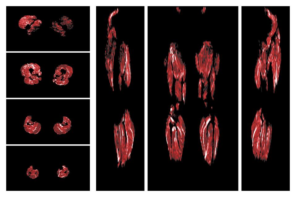 Muscle fiber tract density map based on whole leg DTI based fiber tractography.