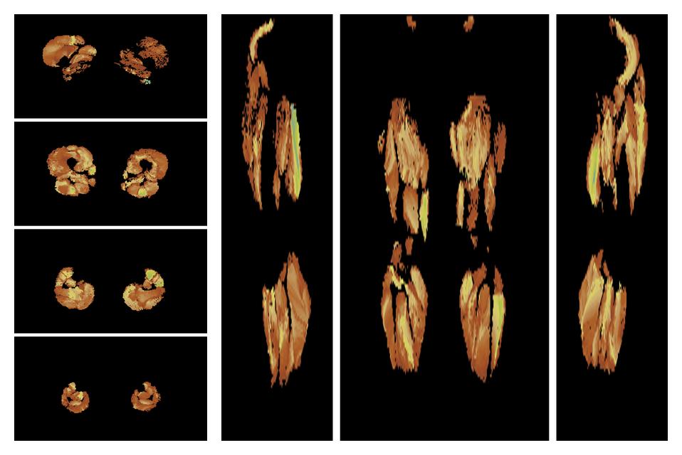 Muscle fiber tract length map based on whole leg DTI based fiber tractography.