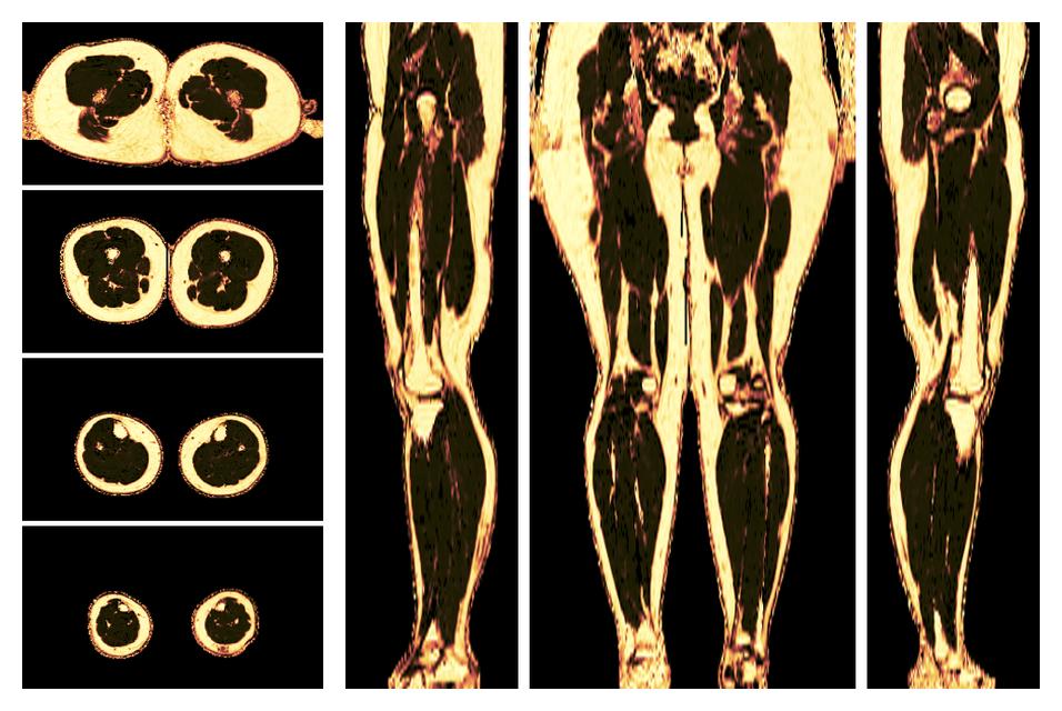 The fat fraction of the lower extremity obtained from the dixon reconstruction for muscle water fat quantification.