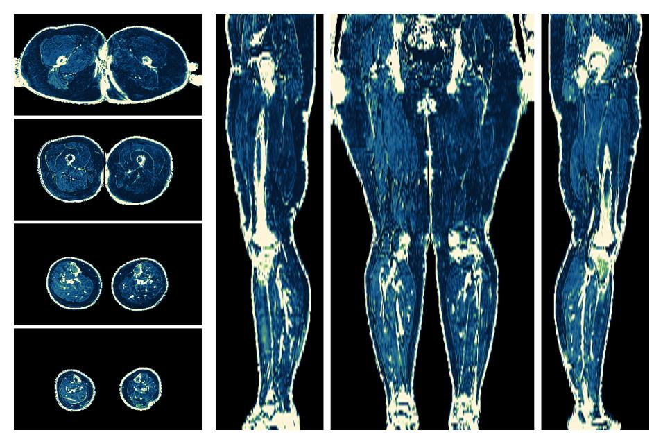 The R2 star relaxation time of the lower extremity obtained from the dixon reconstruction for muscle water fat quantification.