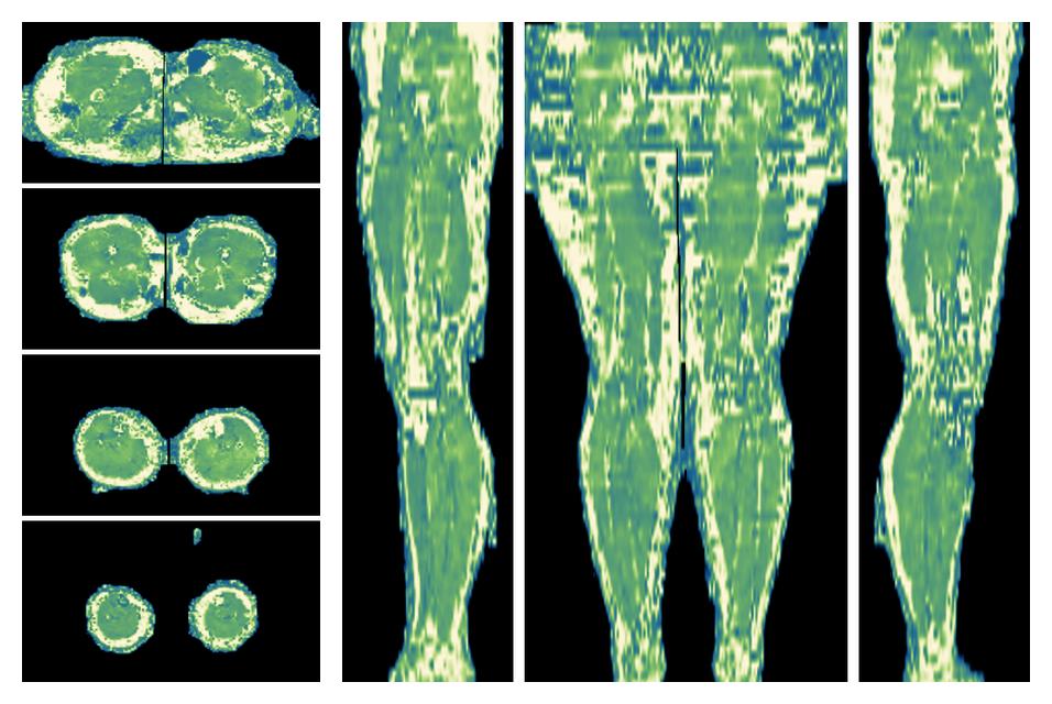 The water only T2 relaxation time of the lower extremity obtained from multi echo spin echo t2 mapping with EPG based reconstruction.