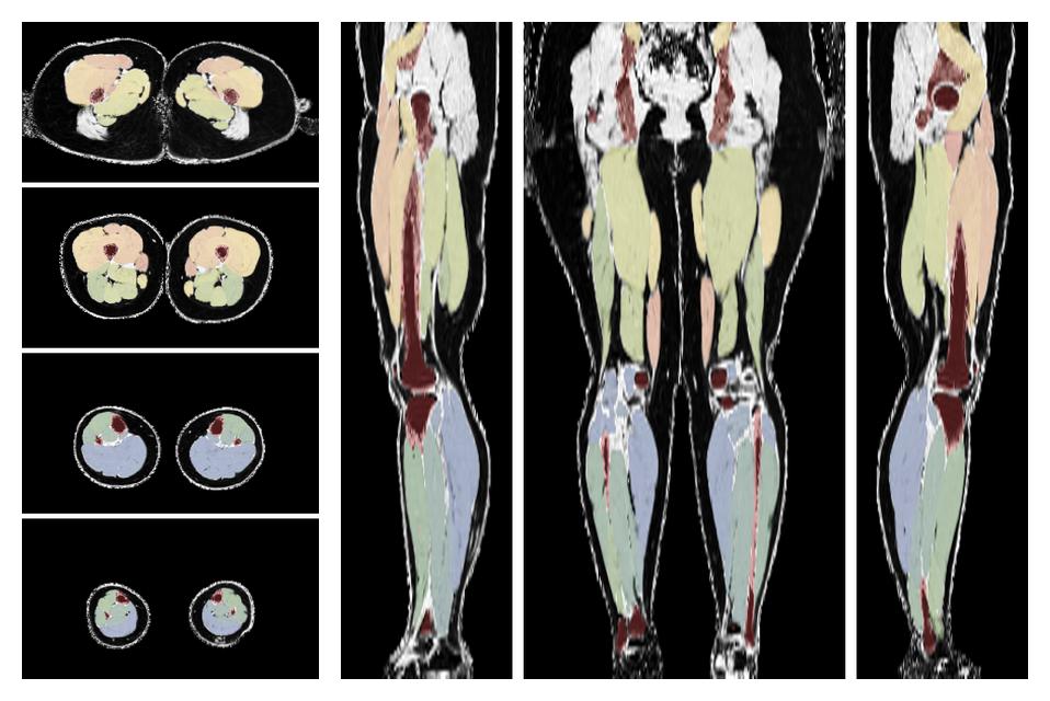 Overlay of automated muscle segmentation labels on dixon water image.