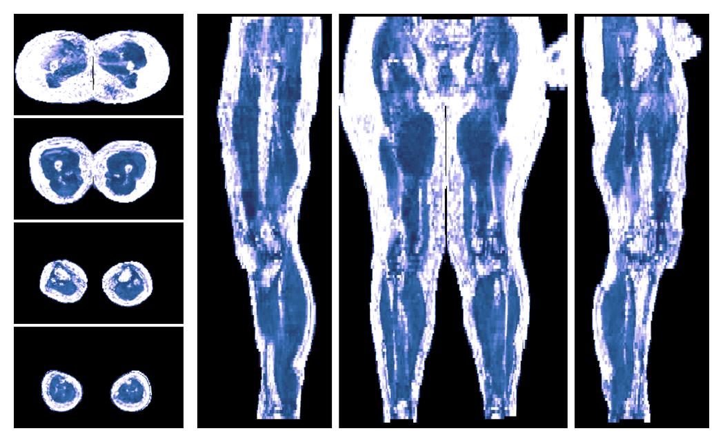 IVIM corrected whole leg muscle fractional anisotropy obtained from diffusion tensor imaging.