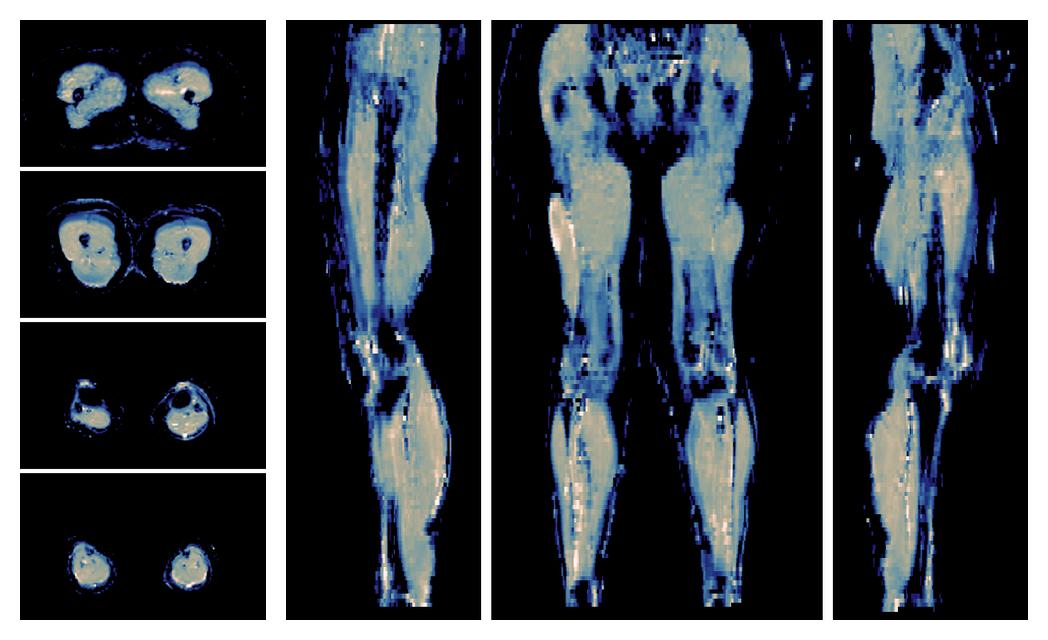 IVIM corrected whole leg muscle mean diffusivity obtained from diffusion tensor imaging.