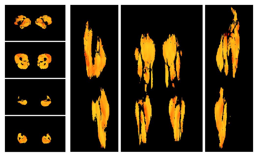 Muscle fiber tract angle map based on whole leg DTI based fiber tractography.