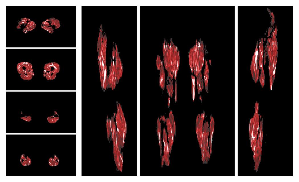 Muscle fiber tract density map based on whole leg DTI based fiber tractography.