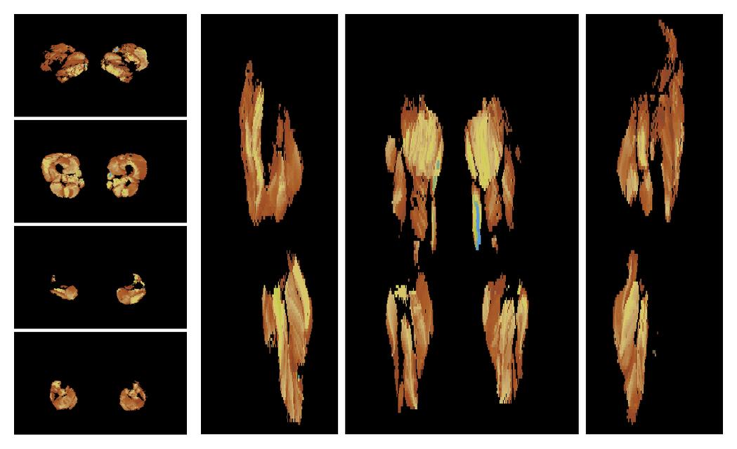 Muscle fiber tract length map based on whole leg DTI based fiber tractography.