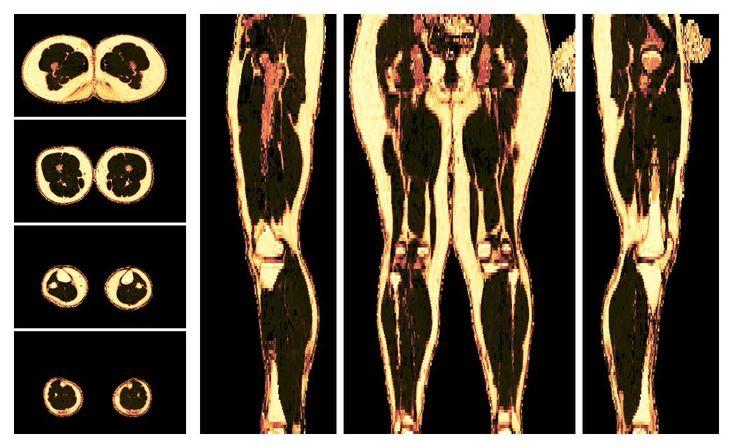 The fat fraction of the lower extremity obtained from the dixon reconstruction for muscle water fat quantification.