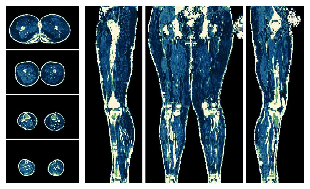 The R2 star relaxation time of the lower extremity obtained from the dixon reconstruction for muscle water fat quantification.