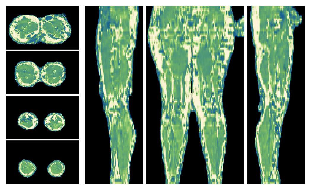 The water only T2 relaxation time of the lower extremity obtained from multi echo spin echo t2 mapping with EPG based reconstruction.