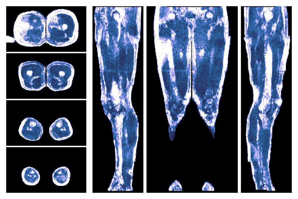 IVIM corrected whole leg muscle fractional anisotropy obtained from diffusion tensor imaging.