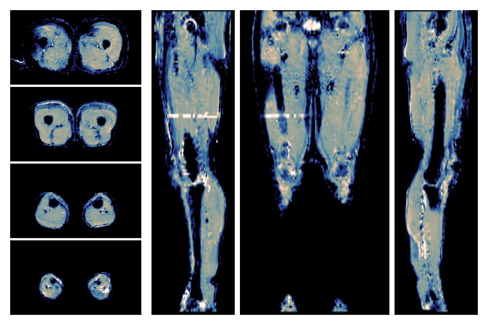 IVIM corrected whole leg muscle mean diffusivity obtained from diffusion tensor imaging.