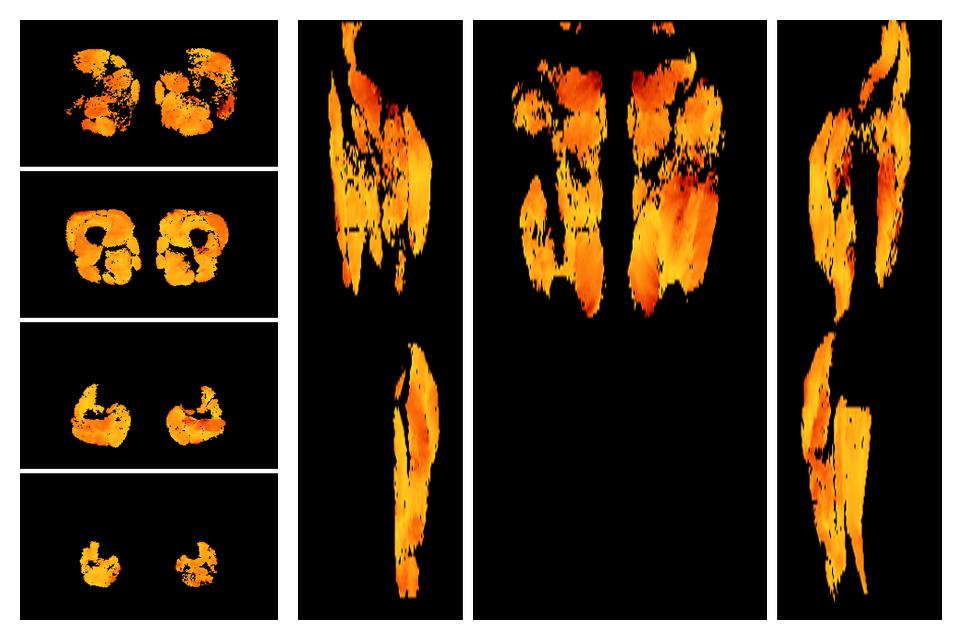 Muscle fiber tract angle map based on whole leg DTI based fiber tractography.