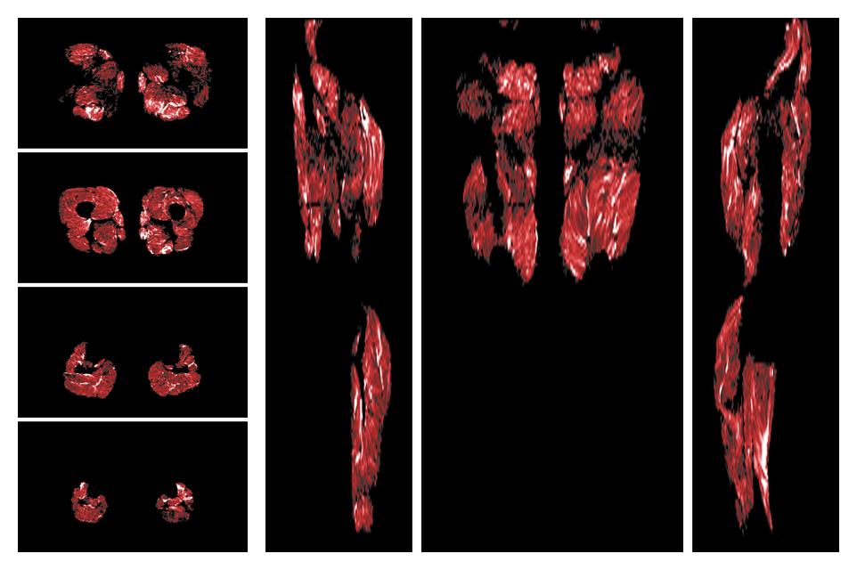 Muscle fiber tract density map based on whole leg DTI based fiber tractography.