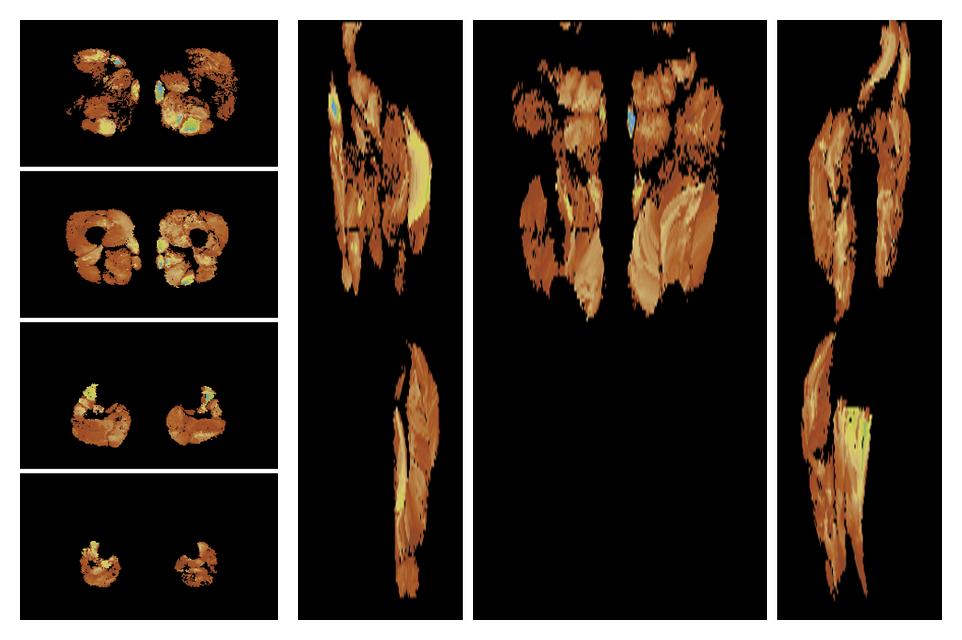 Muscle fiber tract length map based on whole leg DTI based fiber tractography.