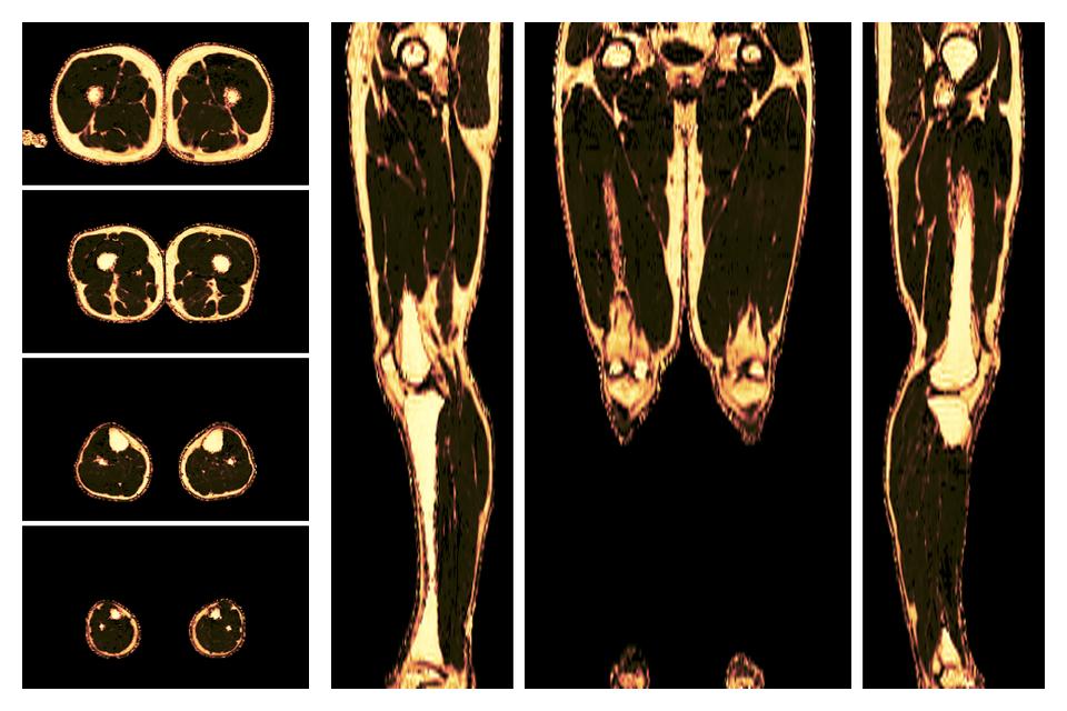 The fat fraction of the lower extremity obtained from the dixon reconstruction for muscle water fat quantification.