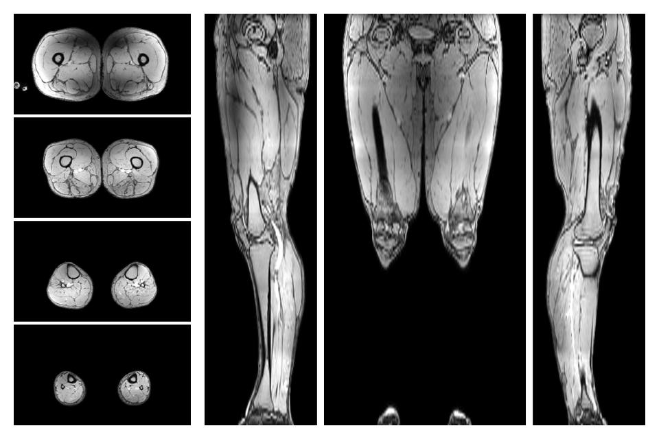 The out-phase image of the dixon reconstruction for water fat quantification.