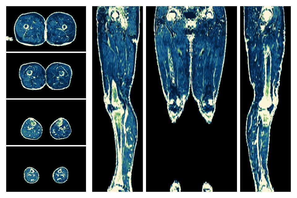 The R2 star relaxation time of the lower extremity obtained from the dixon reconstruction for muscle water fat quantification.