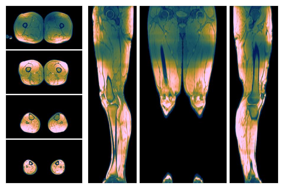 The SNR distribution of the dixon data.