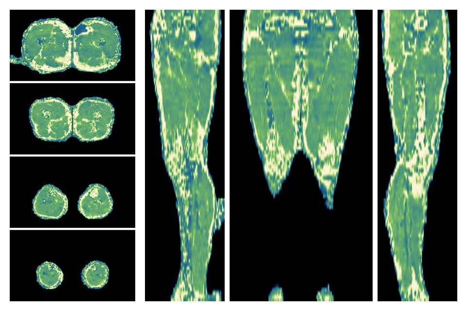 The water only T2 relaxation time of the lower extremity obtained from multi echo spin echo t2 mapping with EPG based reconstruction.