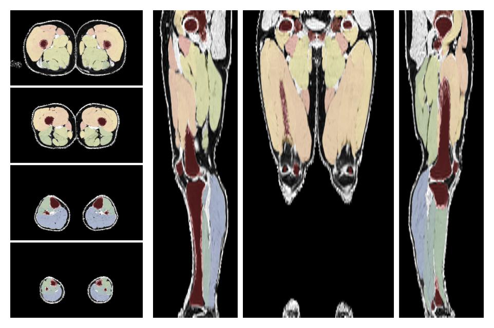 Overlay of automated muscle segmentation labels on dixon water image.