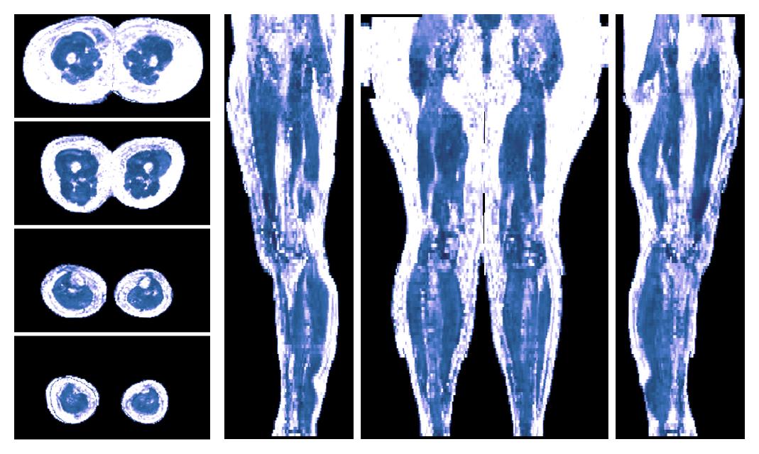 IVIM corrected whole leg muscle fractional anisotropy obtained from diffusion tensor imaging.