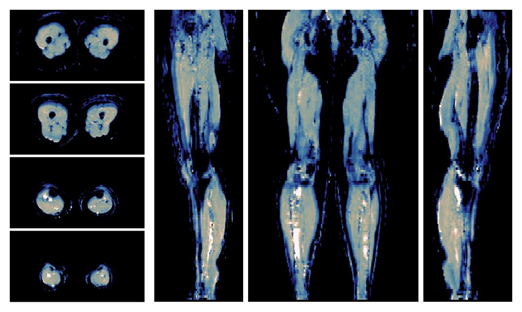 IVIM corrected whole leg muscle mean diffusivity obtained from diffusion tensor imaging.