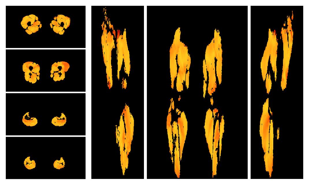 Muscle fiber tract angle map based on whole leg DTI based fiber tractography.