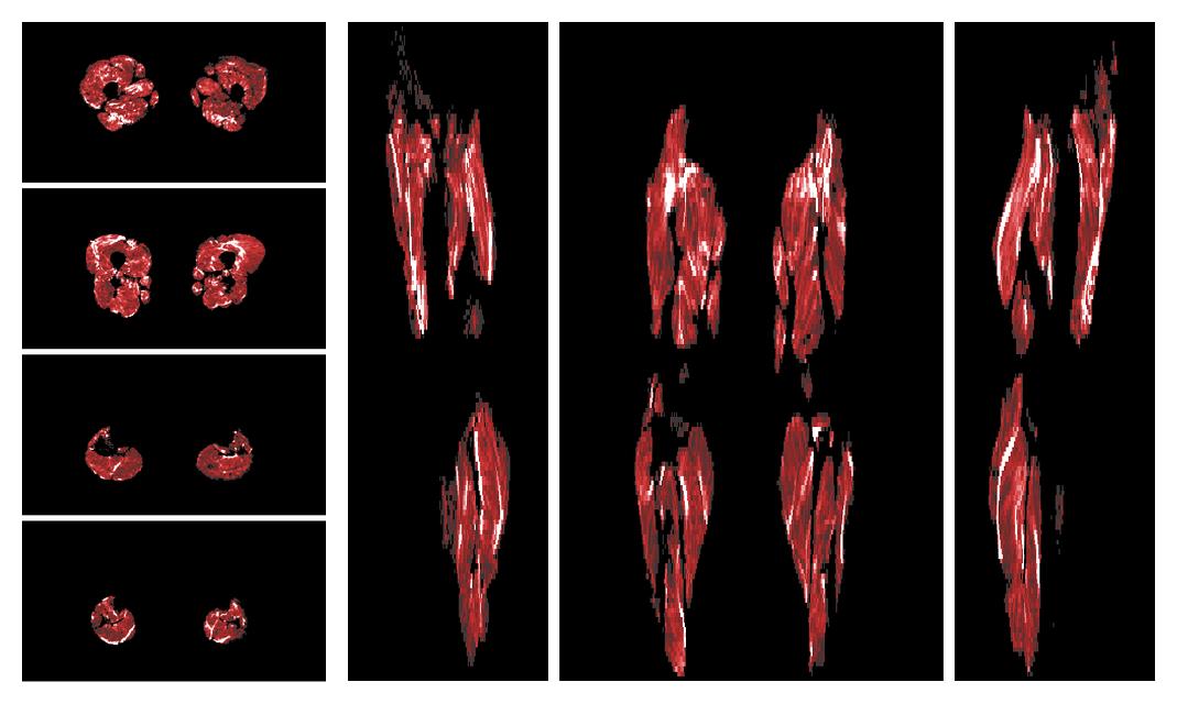 Muscle fiber tract density map based on whole leg DTI based fiber tractography.