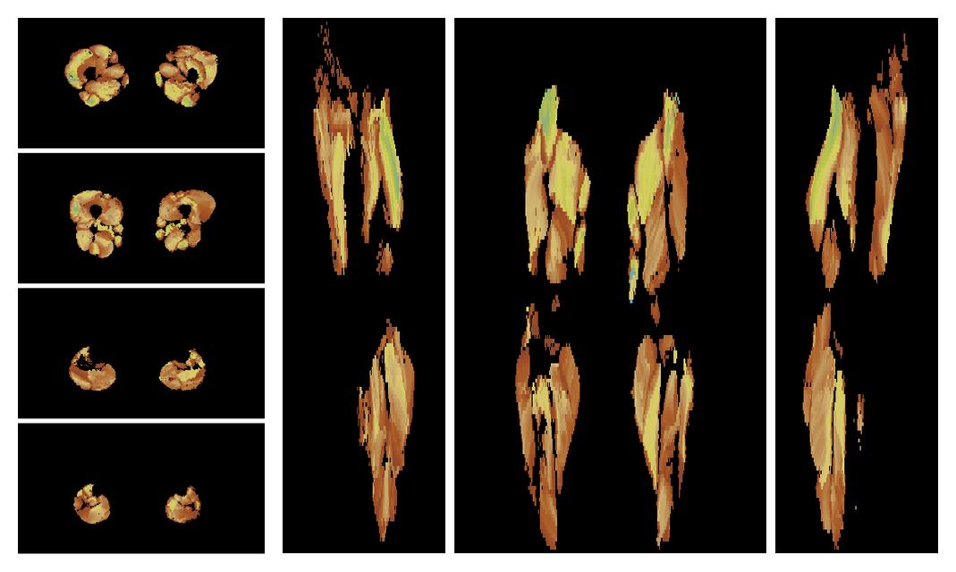 Muscle fiber tract length map based on whole leg DTI based fiber tractography.