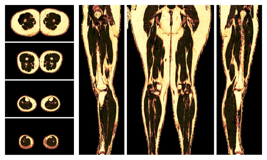 The fat fraction of the lower extremity obtained from the dixon reconstruction for muscle water fat quantification.