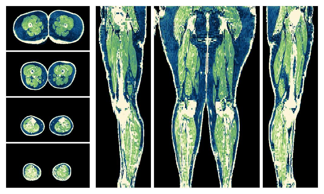 The R2 star relaxation time of the lower extremity obtained from the dixon reconstruction for muscle water fat quantification.