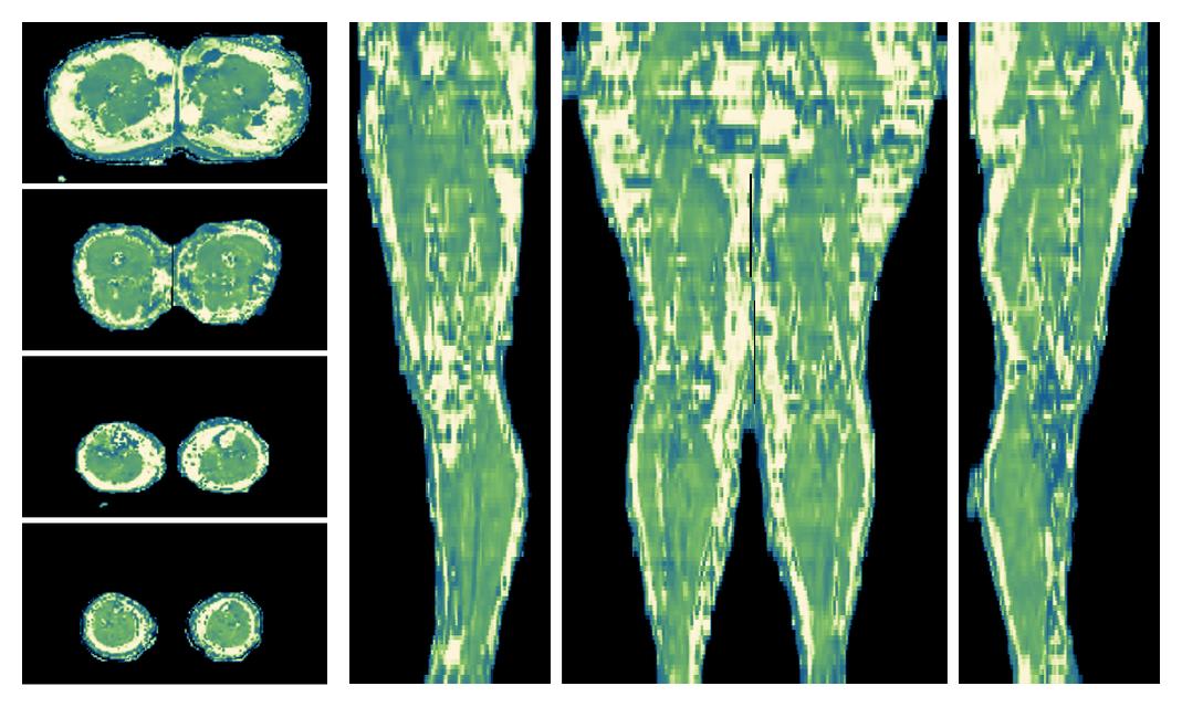 The water only T2 relaxation time of the lower extremity obtained from multi echo spin echo t2 mapping with EPG based reconstruction.