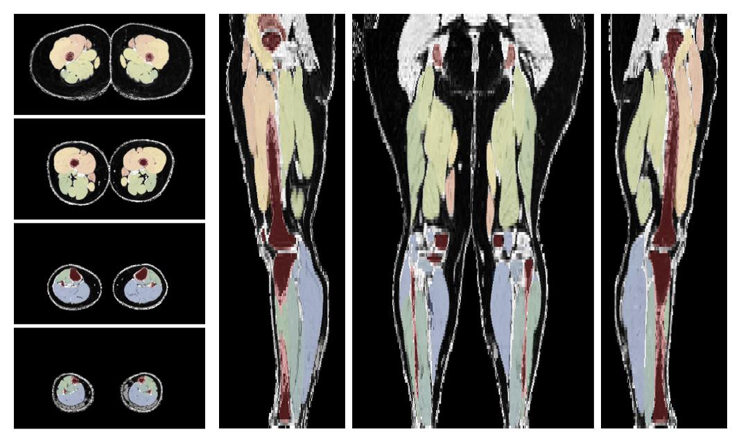 Overlay of automated muscle segmentation labels on dixon water image.