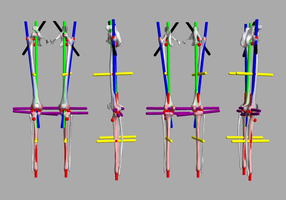 3D render of automated bone segmentation and force lines.