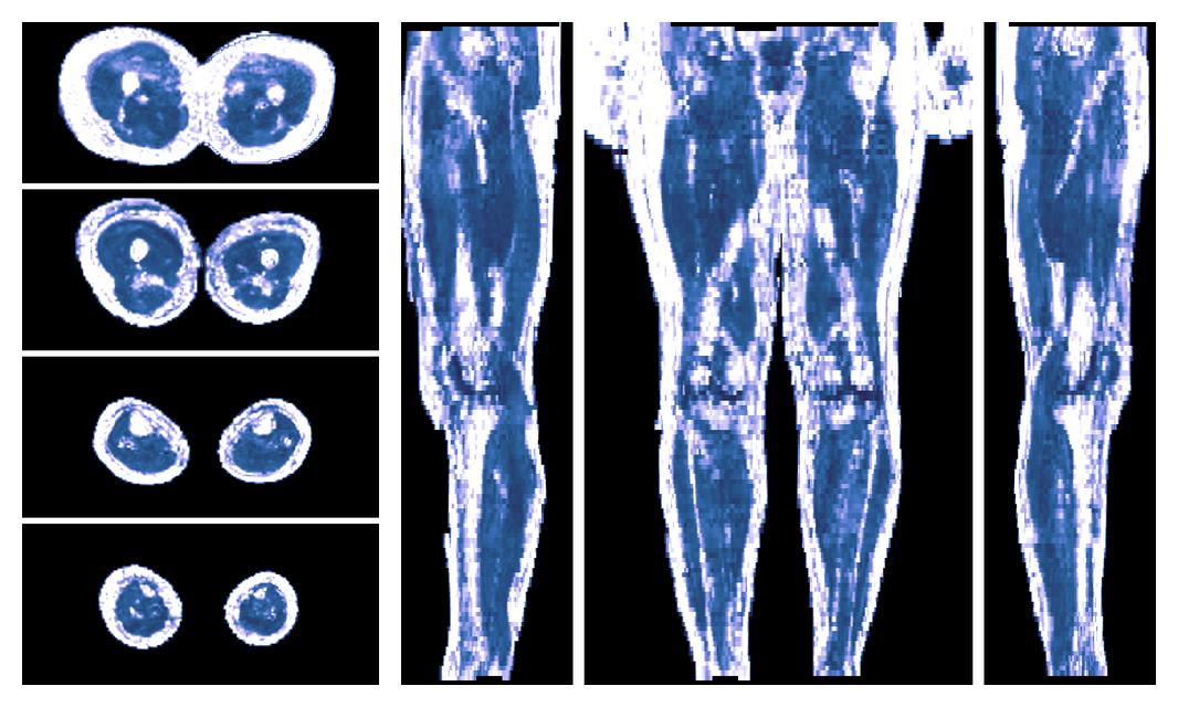 IVIM corrected whole leg muscle fractional anisotropy obtained from diffusion tensor imaging.