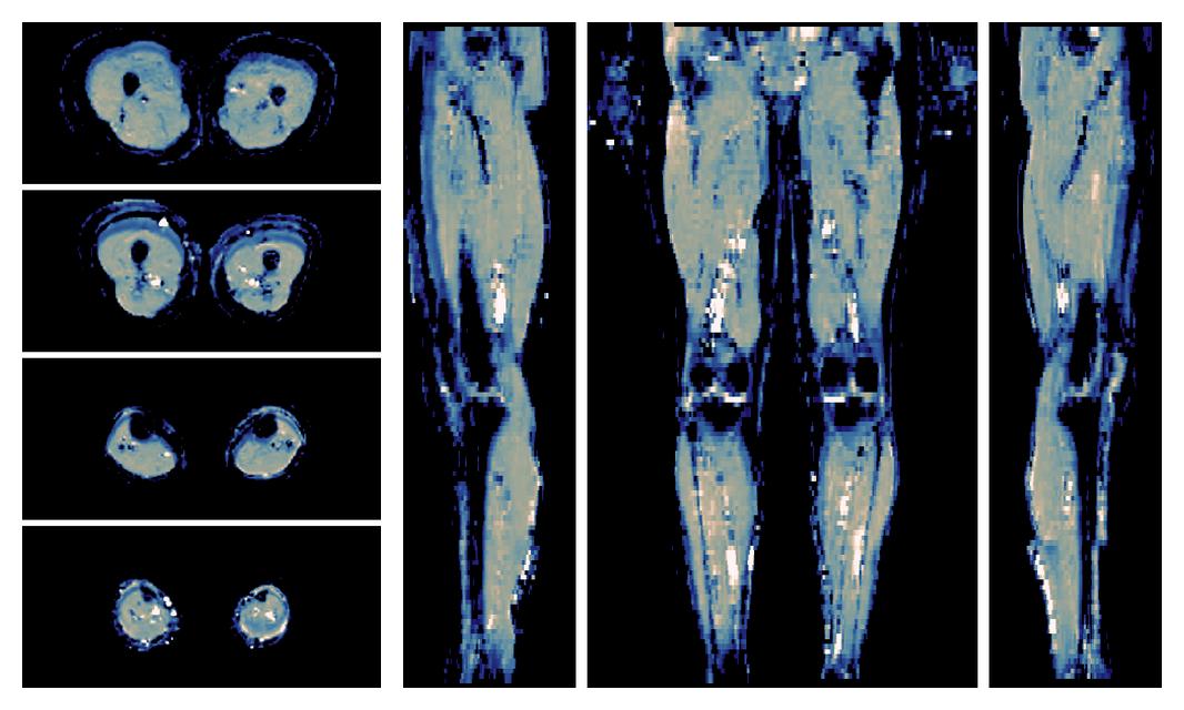 IVIM corrected whole leg muscle mean diffusivity obtained from diffusion tensor imaging.