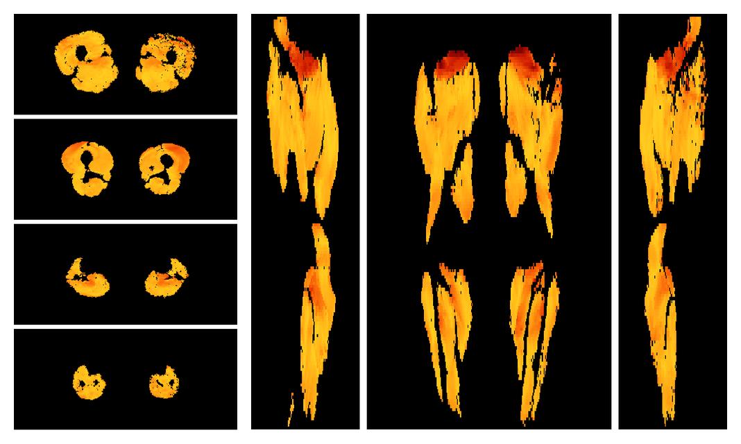 Muscle fiber tract angle map based on whole leg DTI based fiber tractography.