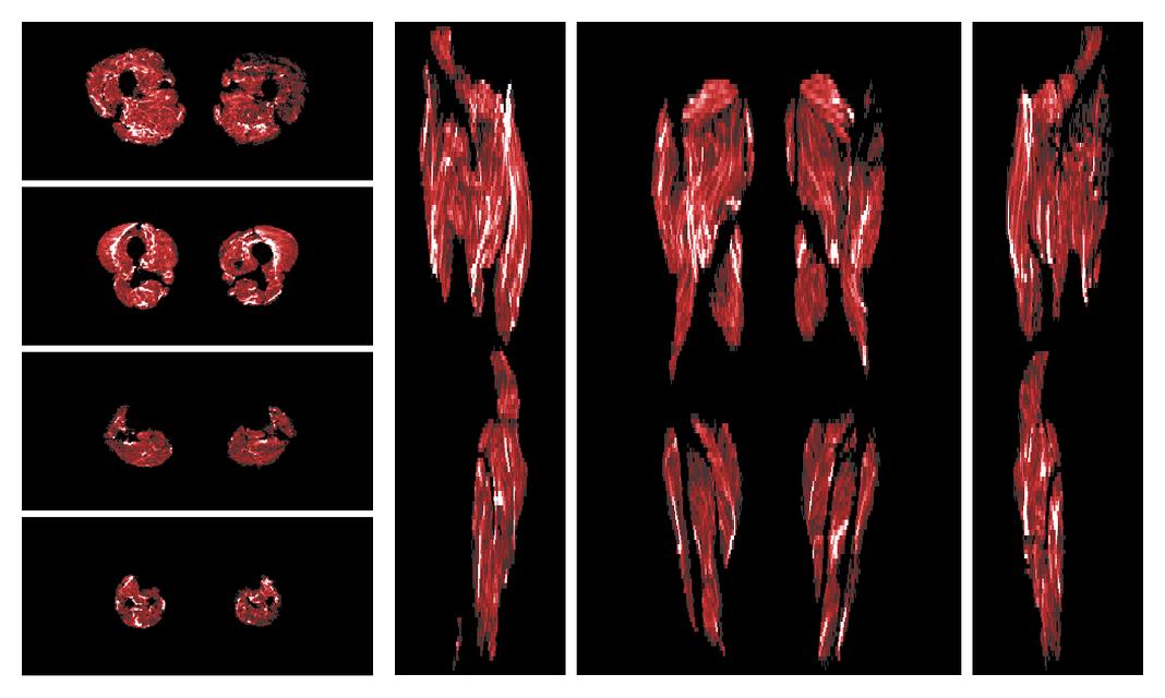 Muscle fiber tract density map based on whole leg DTI based fiber tractography.