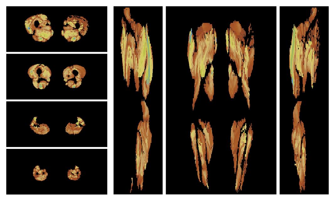 Muscle fiber tract length map based on whole leg DTI based fiber tractography.