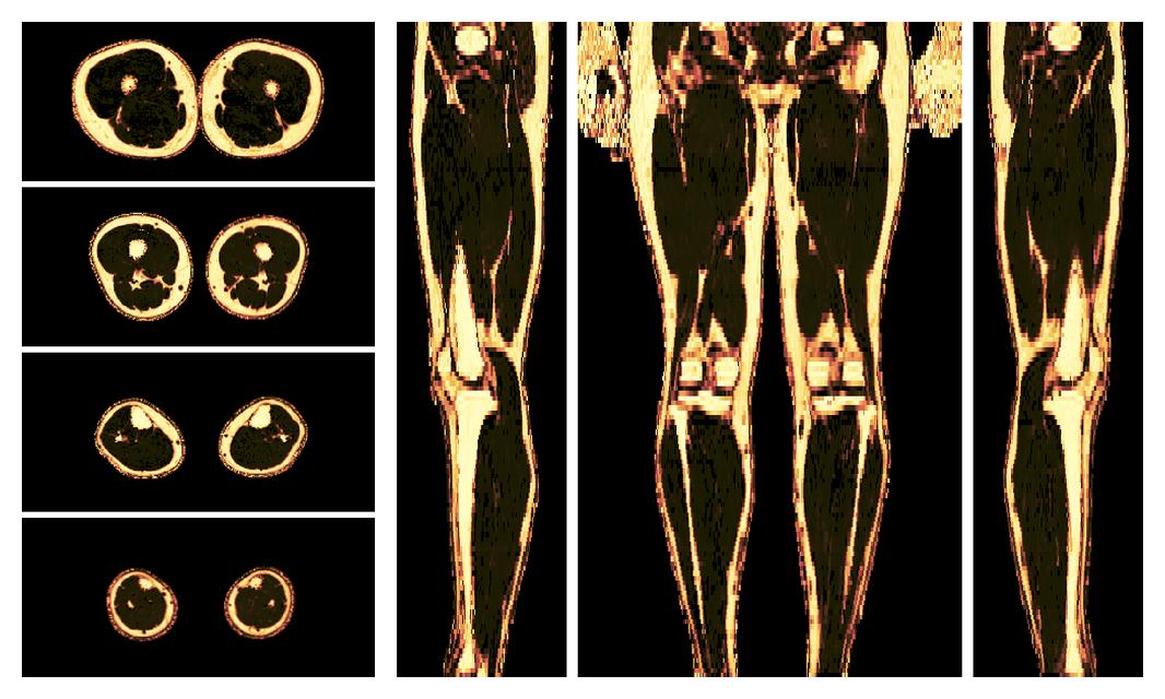 The fat fraction of the lower extremity obtained from the dixon reconstruction for muscle water fat quantification.