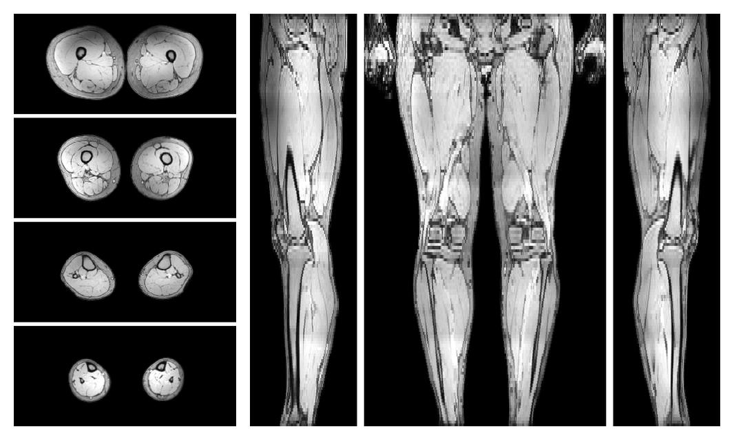 The out-phase image of the dixon reconstruction for water fat quantification.