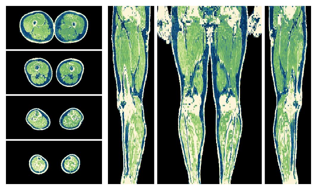 The R2 star relaxation time of the lower extremity obtained from the dixon reconstruction for muscle water fat quantification.