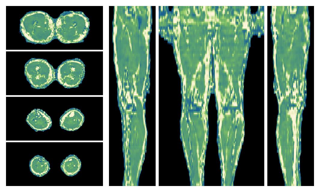 The water only T2 relaxation time of the lower extremity obtained from multi echo spin echo t2 mapping with EPG based reconstruction.