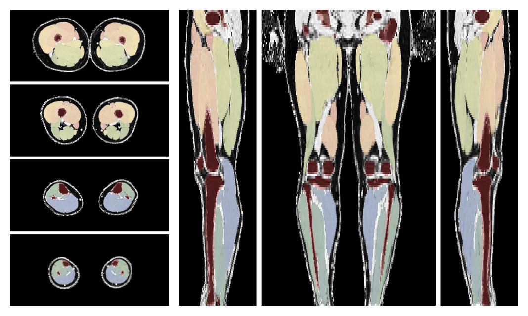 Overlay of automated muscle segmentation labels on dixon water image.