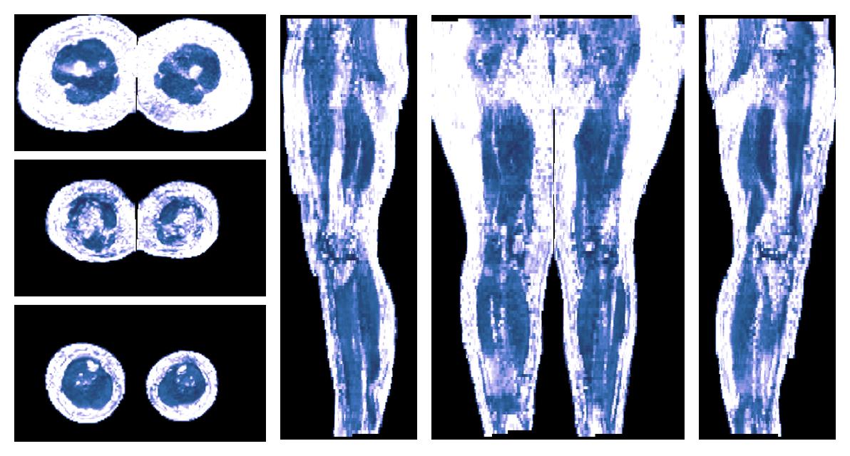 IVIM corrected whole leg muscle fractional anisotropy obtained from diffusion tensor imaging.