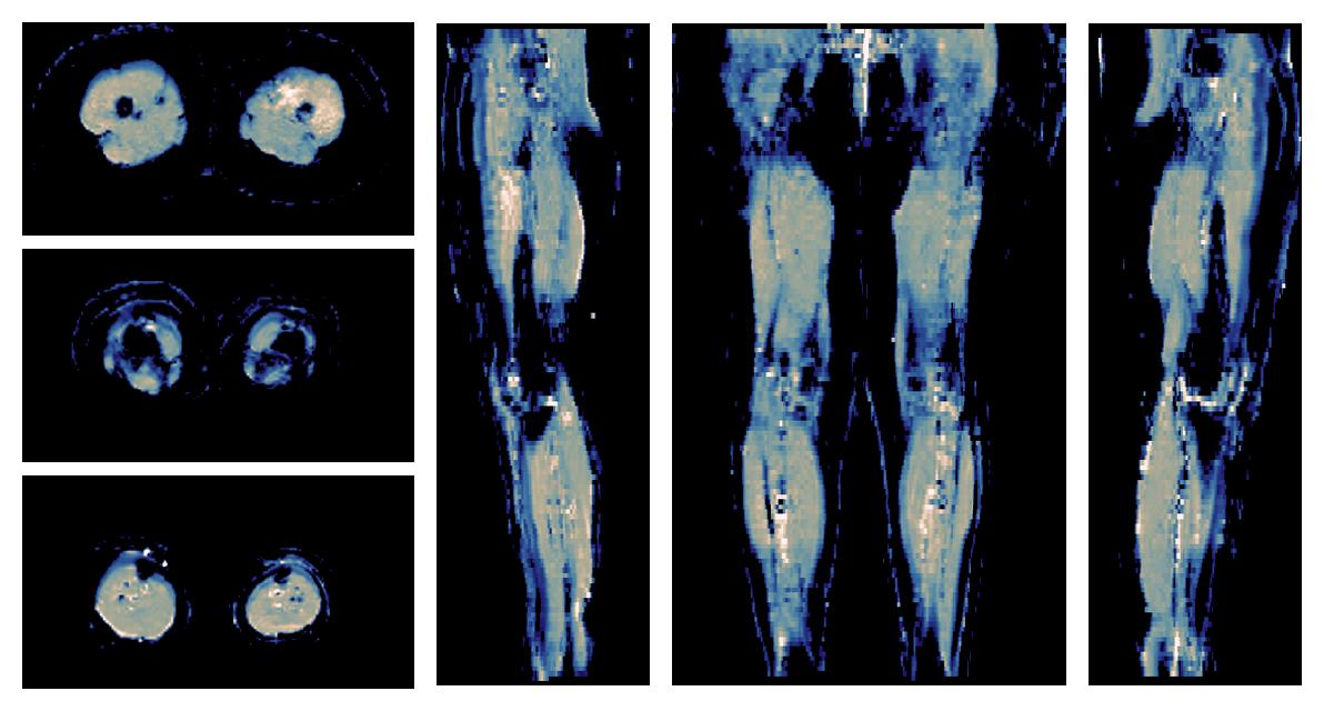 IVIM corrected whole leg muscle mean diffusivity obtained from diffusion tensor imaging.