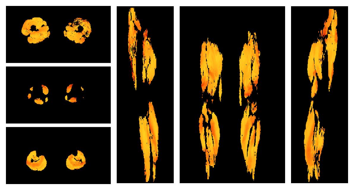 Muscle fiber tract angle map based on whole leg DTI based fiber tractography.